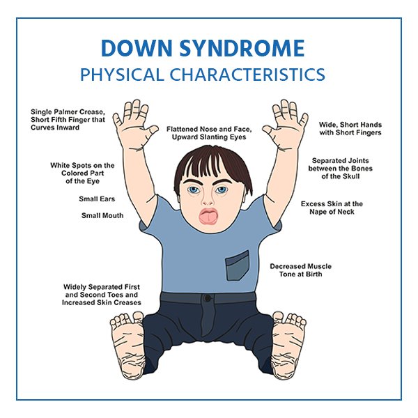 Illustration of baby with Down syndrome.