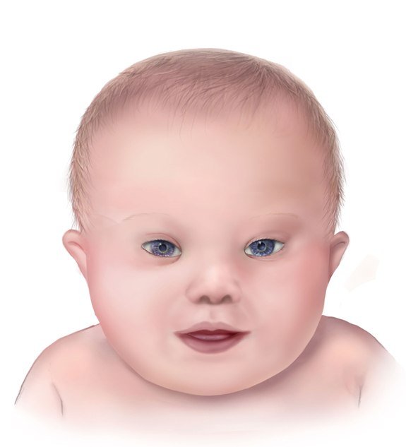 Drawing of child with Down syndrome